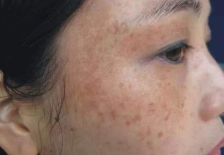How to remove freckles naturally permanently at home