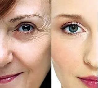 How to choose a facelift